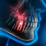 Dental Pain Nerve X-Ray