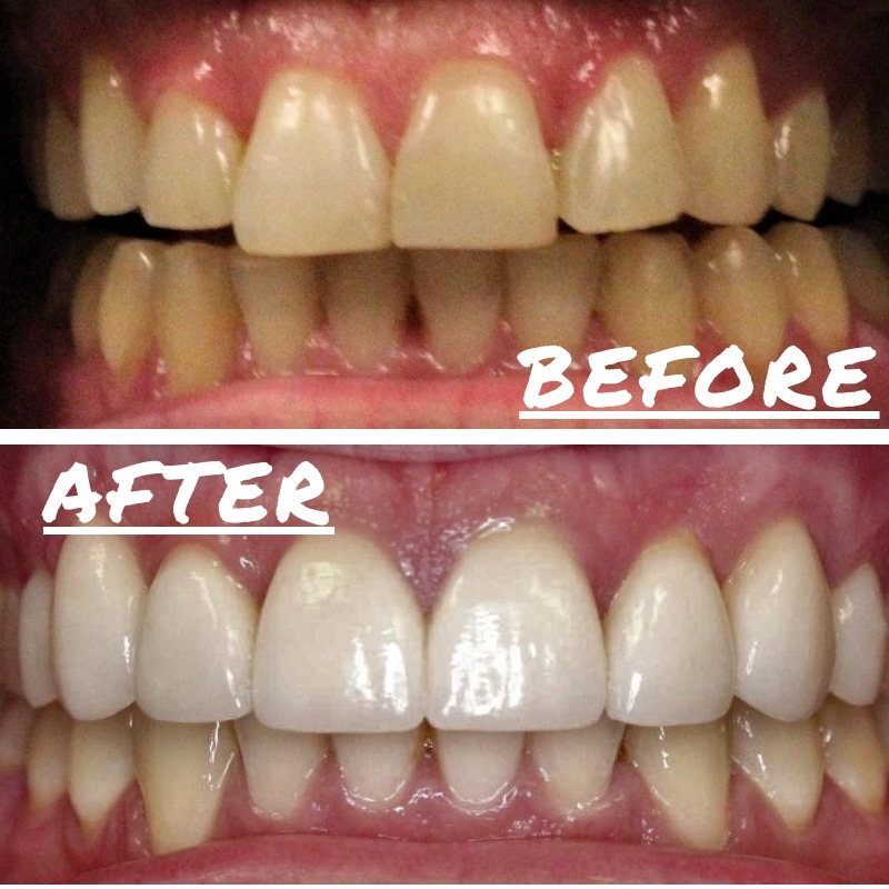 Orthodontics Before and After